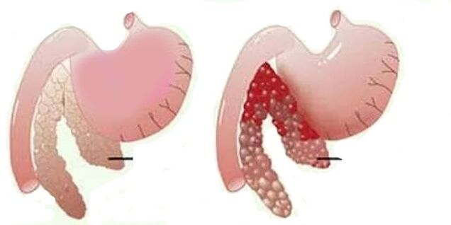 pancreatitis